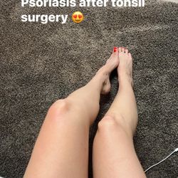 Douglas Smith, MD - Psoriasis after tonsil surgery