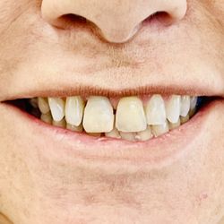 Foothill Smiles - Before