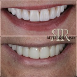 Ritter and Ramsey General and Cosmetic Dentistry - Porcelain Veneers by Ritter and Ramsey Award Winning Cosmetic Dentists