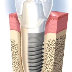 Verde Dental Care - We now offer implants! Call now to make an appointment for a consultation.