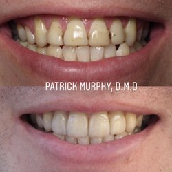 Murphy Dental Group - Porcelain Crowns replacing old composite bonding