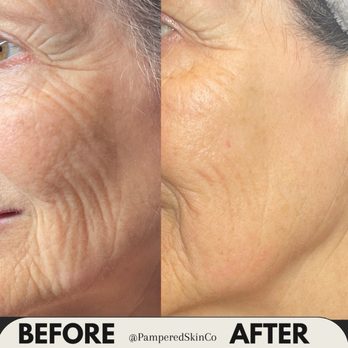 Pampered Skin Co. LLC - Jet plasma and XPeel5 combo - Skin Care Near Me - Salem, Oregon Pampered Skin Co. LLC - Jet plasma and XPeel5 combo - Skin Care Near Me - Salem, Oregon