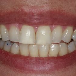 Most Dental - No prep Veneers (before)