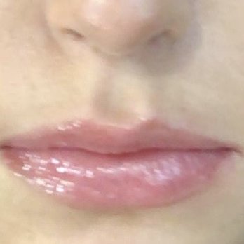 Dermacare Brickell - 4 days after lip flip - Skin Care Near Me - Miami, Florida