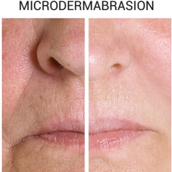 Caryl Baker Visage - Microdermabrasion - Before and After - Cosmetics & Beauty Supply Near Me - Vaughan, Ontario Caryl Baker Visage - Microdermabrasion - Before and After - Cosmetics & Beauty Supply Near Me - Vaughan, Ontario
