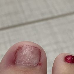 Swan's Nail Spa - Right foot 2 days after pedicure. Infection and inflammation on sides of toenail. Took polish off myself to be seen for infection.