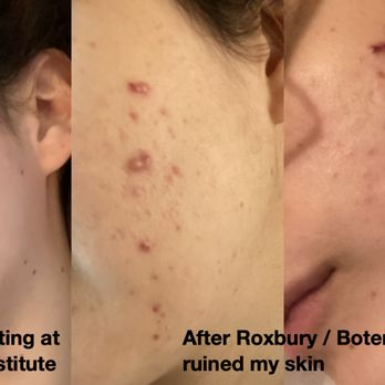 The Roxbury Institute - Roxbury Institute ruined my skin - Dermatologists Near Me - Beverly Hills, California The Roxbury Institute - Roxbury Institute ruined my skin - Dermatologists Near Me - Beverly Hills, California