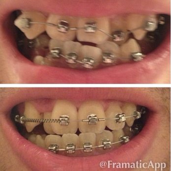 Benham Orthodontics - First day in braces and then 6 months after braces after extractions - Orthodontists Near Me - Frisco, Texas Benham Orthodontics - First day in braces and then 6 months after braces after extractions - Orthodontists Near Me - Frisco, Texas