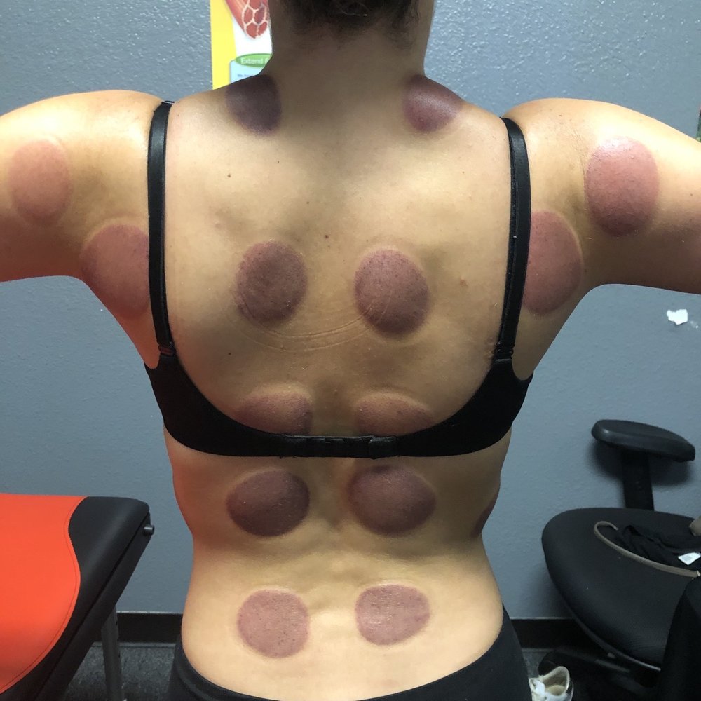 The Massage Dude - first time cupping immediately after! - Massage Therapy Near Me - Riverside, California