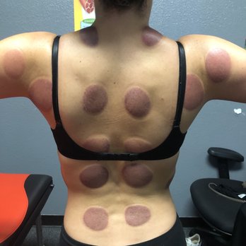 The Massage Dude - first time cupping immediately after! - Massage Therapy Near Me - Riverside, California