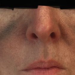 Modern Medical Aesthetics - It got worse everyday. This was around 15 days after