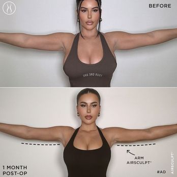 AirSculpt - San Jose - Body Contouring Near Me - San Jose, California AirSculpt - San Jose - Body Contouring Near Me - San Jose, California
