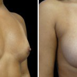 Matthew Goodwin, MD - Tenet Florida Physician Services - Breast Augmentation Before & After