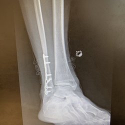Jonathan Kaplan, MD - Irvine Office - Plate and 6 screws in ankle. I'm ready to go now!