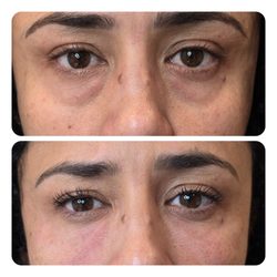 MedAndSpa - PRFM Under Eye treatment