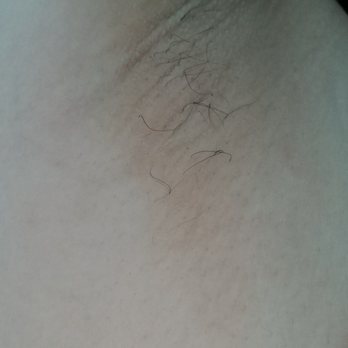 SEV Laser - Underarms after 8 laser sessions - Laser Hair Removal Near Me - San Francisco, California SEV Laser - Underarms after 8 laser sessions - Laser Hair Removal Near Me - San Francisco, California