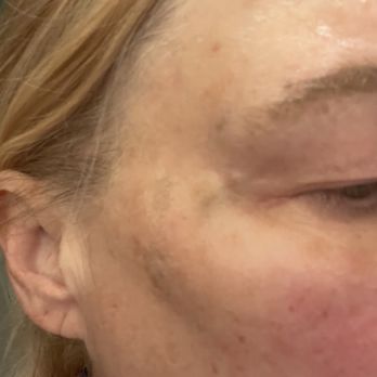 Injected Artistry - Week after Botox prickle - Medical Spas Near Me - Monterey, California