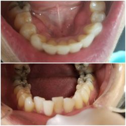 Ajmal Dental Care - Before & after braces