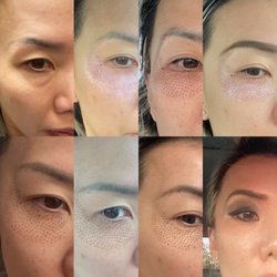 Heavenly Aesthetics - 8 days between before and after procedure. No bags!