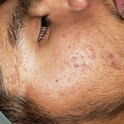 Liz Hall - This is him after 3 treatments. Believe and we can achieve! He is fabulous to work with!