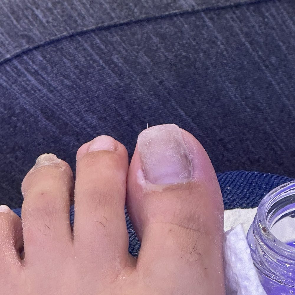 Fancy Nails - Closer look of the white chemical burn on my big toe bottom left corner under the corner of my nail - Nail Salons Near Me - Seguin, Texas Fancy Nails - Closer look of the white chemical burn on my big toe bottom left corner under the corner of my nail - Nail Salons Near Me - Seguin, Texas