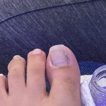 Fancy Nails - Closer look of the white chemical burn on my big toe bottom left corner under the corner of my nail - Nail Salons Near Me - Seguin, Texas