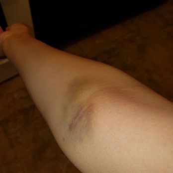 BioLife Plasma Services - Bruises on my right arm - Blood & Plasma Donation Centers Near Me - Villa Park, Illinois BioLife Plasma Services - Bruises on my right arm - Blood & Plasma Donation Centers Near Me - Villa Park, Illinois