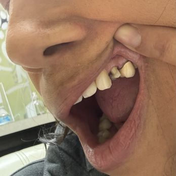 Affordable Dental - The crown that fell off - Cosmetic Dentists Near Me - Van Nuys, California Affordable Dental - The crown that fell off - Cosmetic Dentists Near Me - Van Nuys, California