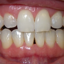 Louis P. Sterling, DDS - Black triangle between the lower front teeth was annoying this patient.