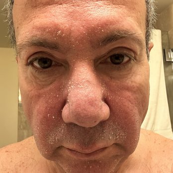 Zavant Aesthetics - Before the treatment - Laser Hair Removal Near Me - Burbank, California