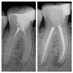 Aventura Endodontic Group - Re-treating a incomplete root canal