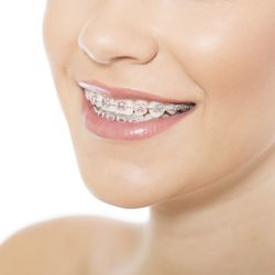 Just For Grins Orthodontics - Achieve the beautiful smile you've always wanted. Contact Dunn & Schreiber Orthodontics today!