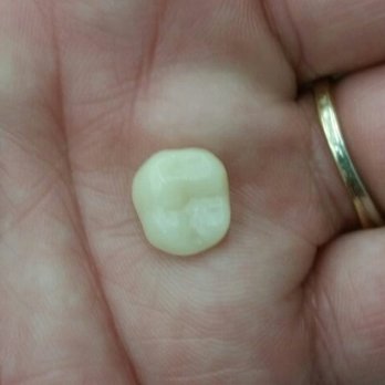 Belton Modern Dentistry - My tooth before Dr. Juarez fixed it!!! - General Dentistry Near Me - Belton, Missouri Belton Modern Dentistry - My tooth before Dr. Juarez fixed it!!! - General Dentistry Near Me - Belton, Missouri