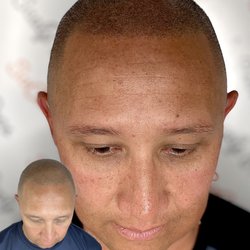 Scalp Mora Pigmentation