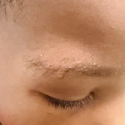 The Learning Experience - Durham - Swelling and bruising on my child's right eye due to TLE Durham's negligence.