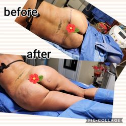 MediSpa Solutions - Beautifill fat grafting and transfer