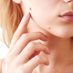 Medix Skincare & Laser Clinic - Safe and precise removal of skin tags and moles at Medix Skincare Melbourne!