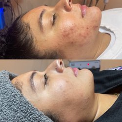 Driftwood Esthetics - Acne scars and non-inflamed acne.