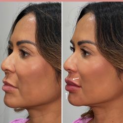 Lip Filler