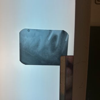 AFAM Dental - Xray of after my root canal retreat picture attached, look at how much infection is gone - General Dentistry Near Me - Brooklyn, New York