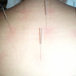Denise Patnod Acupuncture Clinic - Pink areas around the tiny needles release tension