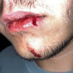 HonorHealth Urgent Care - West Bell Road - Gashed lip