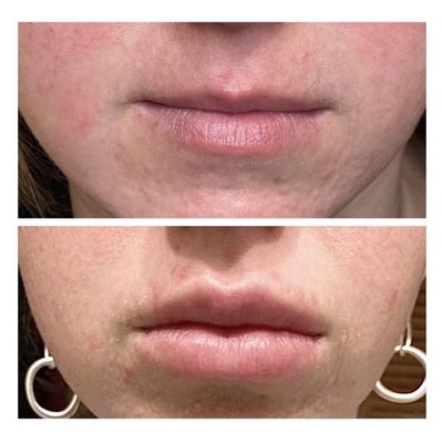 Dermal Fillers - Hyaluronic acid, or HA, is a natural substance in the body that delivers volume to the skin. Getting treated with HA helps add volume to different areas of the face without the risk of surgery while also temporarily restoring the volume loss beneath the surface lasting anywhere from 6-24 months. Dermal Fillers - Hyaluronic acid, or HA, is a natural substance in the body that delivers volume to the skin. Getting treated with HA helps add volume to different areas of the face without the risk of surgery while also temporarily restoring the volume loss beneath the surface lasting anywhere from 6-24 months.