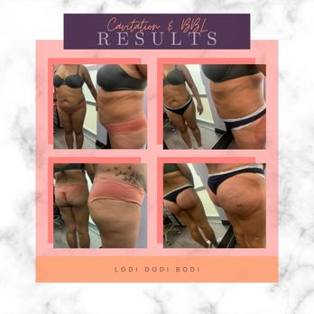Lodi Dodi Bodi - Body Contouring Near Me Lodi Dodi Bodi - Body Contouring Near Me