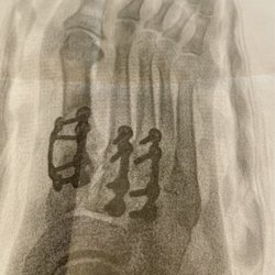 West Hartford Podiatry Associates - 31 stitches, 3 incisions to fix my bunion