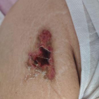 Amarsi Assisted Living - My wife's leg that they didn't take care of - Assisted Living Facilities Near Me - Glendale, Arizona Amarsi Assisted Living - My wife's leg that they didn't take care of - Assisted Living Facilities Near Me - Glendale, Arizona