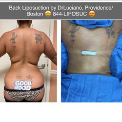 Skinsational Laser Center - Back Lipo under local anesthesia. Good buy BRA rolls!