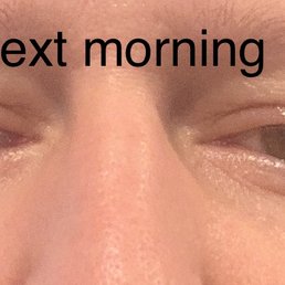 Lash Enhancement. Minimal swelling. I have been fortunate not to have any discomfort during the procedure or afterwards. Lash Enhancement. Minimal swelling. I have been fortunate not to have any discomfort during the procedure or afterwards.