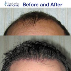 Nashville Hair Clinic - Before and after!