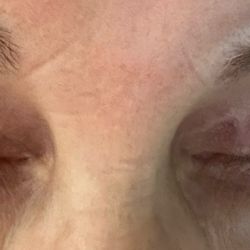 Beauty by Brueck - Dr. Robert Brueck - Two years after upper Bleph by Dr. Brueck, Train tracks